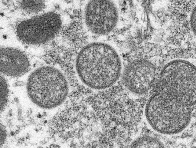 美国专家警告：猴痘疫情在美国有失控风险