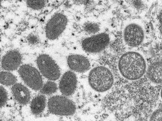 美媒：美国两名儿童感染猴痘 或因家庭传播
