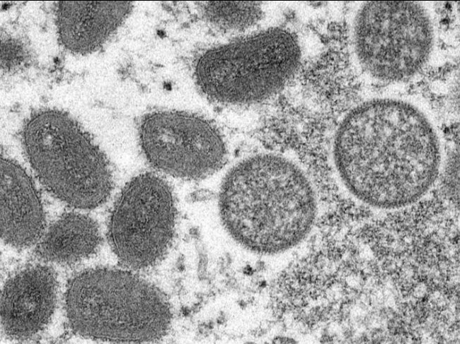 巴西和西班牙出现首例猴痘死亡病例