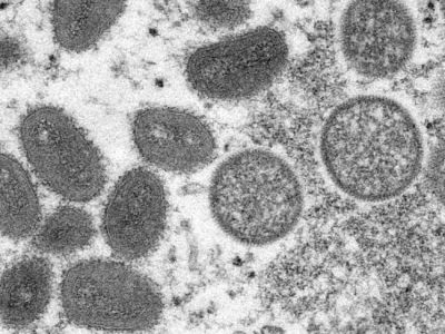 印度已确认6例猴痘病例