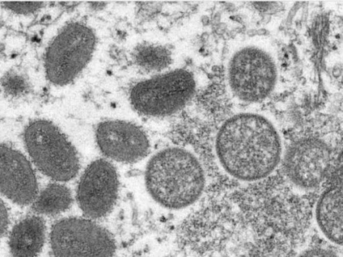 美国出现首例猴痘死亡病例
