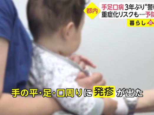 日本手足口病患者激增：确诊者幼儿居多，呈重症化倾向