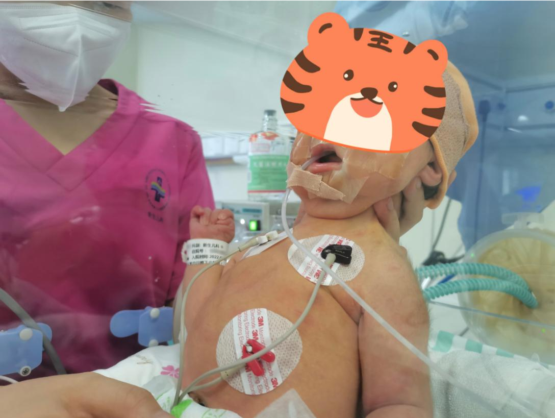 出生后呼吸急促表情呆滞！深圳市三院救治罕见重症肌无力新生儿