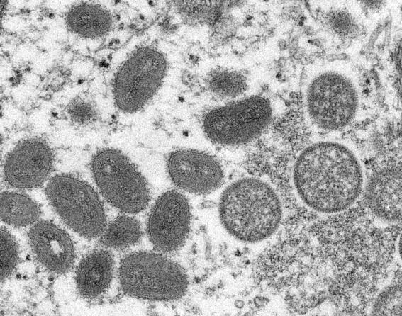 巴西猴痘确诊病例达2415例