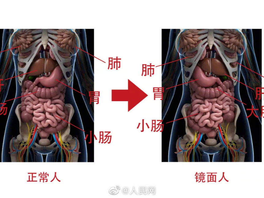 罕见！一女子五脏六腑全部反着长