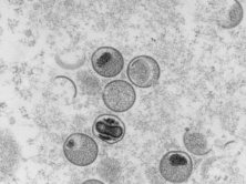 美国纽约州报告第一例未成年猴痘病例
