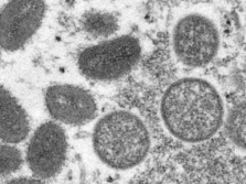 秘鲁猴痘确诊病例超过2千例