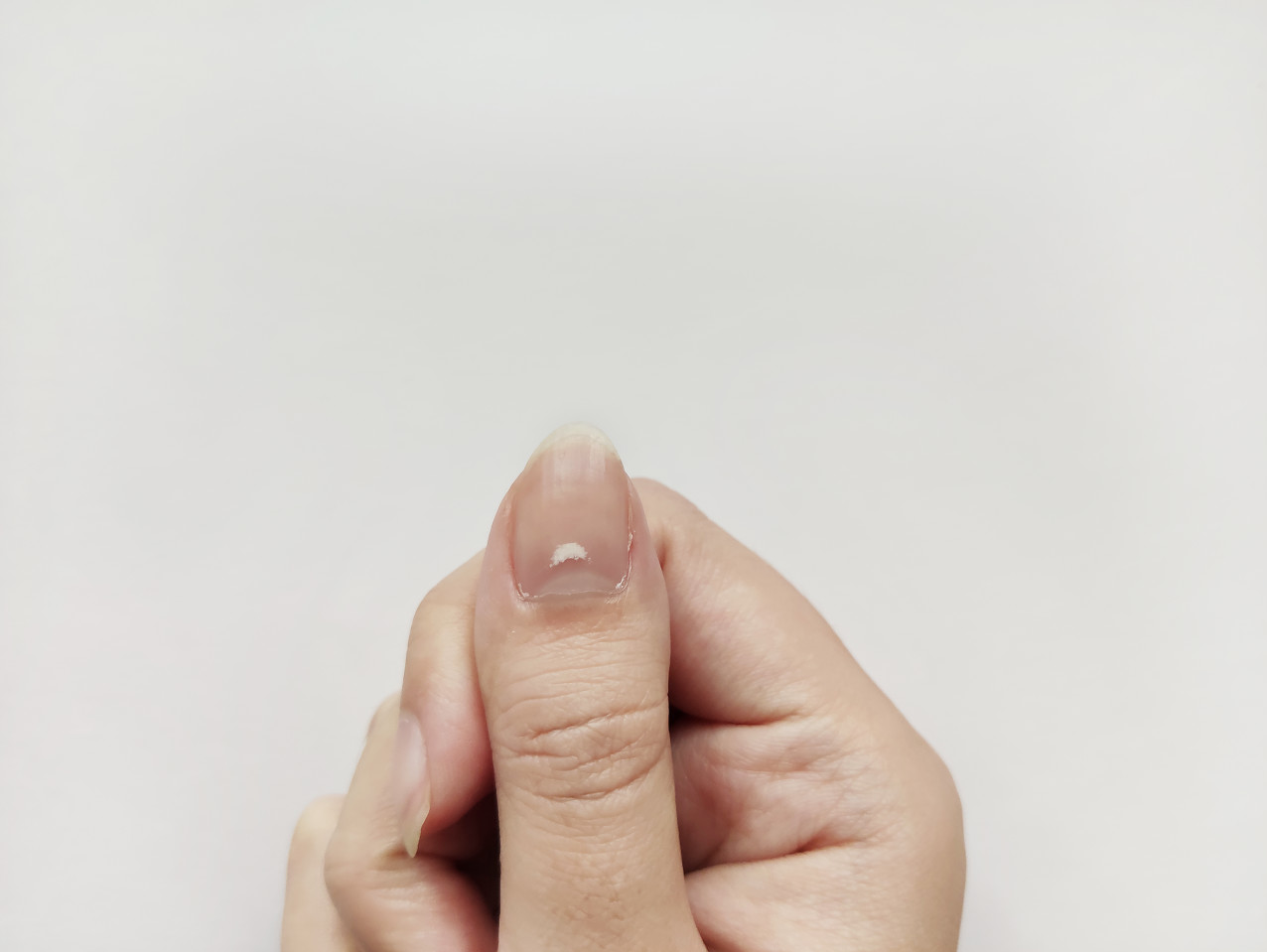 指甲长白点不是缺钙！真要担心的指甲是这样的……