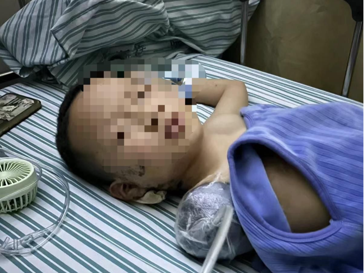 被炮仗炸伤截肢男孩再次手术，体内残留碎片完全清除或需两三年