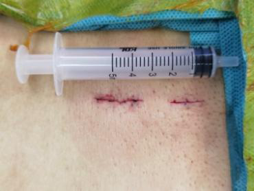 手术切口仅1厘米，微创手术帮患者解决10年腰椎间盘突出顽疾