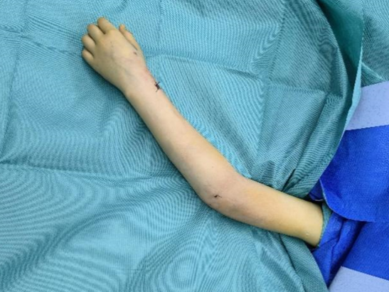 9岁女童不慎摔伤骨折 医生8mm微创接骨