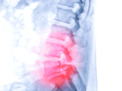 切口小、创伤小！6毫米脊椎内镜手术解决“腰间盘突出症”