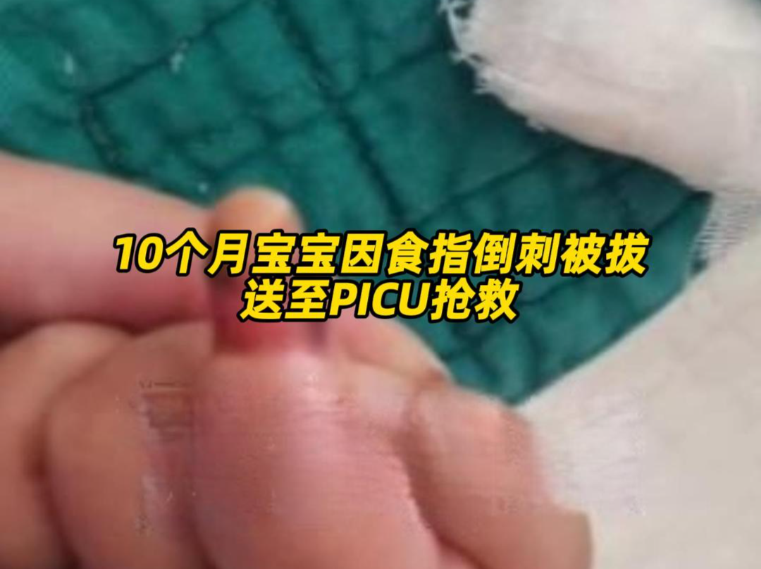 10个月宝宝食指倒刺被拔送PICU抢救