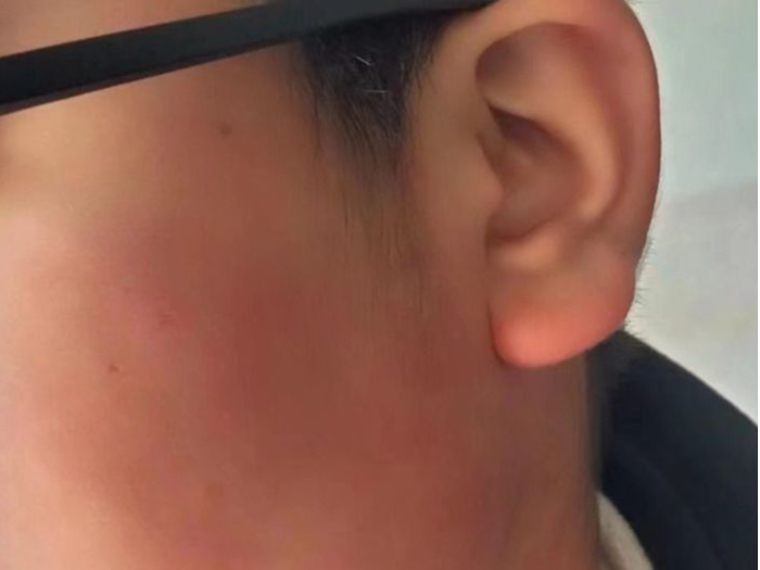 张家口13岁男孩被教师扇耳光致视力严重受损？教体局：已停职 