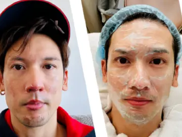 “幸亏这个动作救了我”知名男星自曝脸部二级烧伤