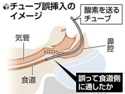 日本一高中生全麻拔智齿后死亡 疑似氧气管误插入食道