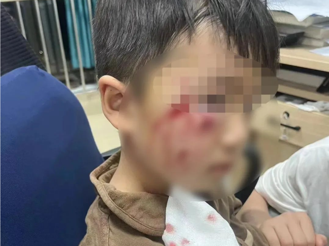 狂犬病病死率近100% ，遭遇犬伤怎么办？