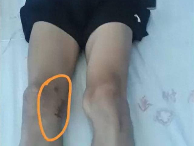 17岁体育生切左膝骨瘤却被错切右膝，当地介入调查 