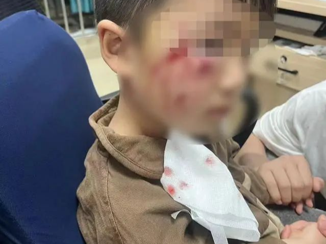 痛心！被咬伤18天后，3岁男童离世，母亲最新发声