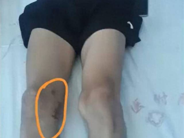 广西百色17岁体育生左膝骨瘤被错切右膝，医院6人被追责