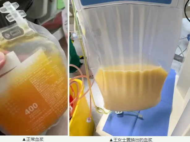 突然深夜肚痛，东莞一女士体内抽出了3000毫升“牛奶血”