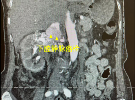 年近八旬阿婆血尿 竟是肾脏肿瘤侵入肝脏