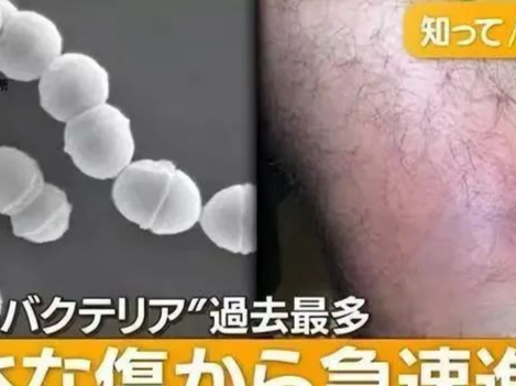 日本超千人感染，有患者截肢保命！“食人菌”为何这么厉害？