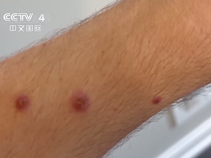 警惕！飞沫也能传播！猴痘变异株蔓延中，如何防控？