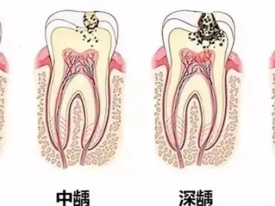 品质服务｜免费福利！有效预防儿童龋病，这件事很关键！ 