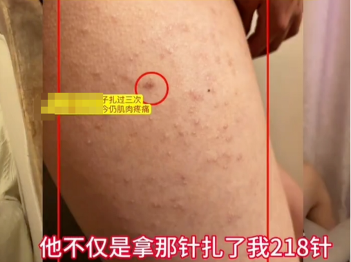 “女生被同桌扎218针”未达到校园霸凌标准？多方回应
