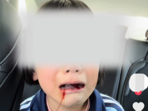 山西一年级女生被同学打得满嘴流血？当地相关部门回应：已介入调查