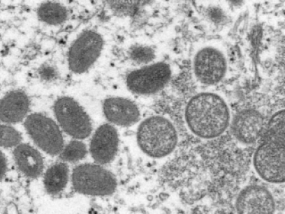 英国报告首例猴痘病毒新变种感染病例