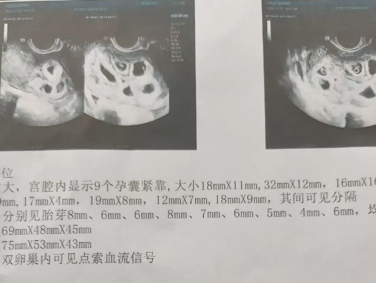 怀九胞胎女子已进行第二次减胎手术，最终留下两胎 