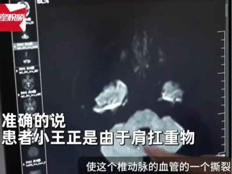 26岁小伙突发脑梗，竟跟身上的背包有关！医生提醒→
