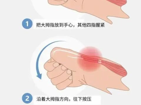 专家科普｜得了“妈妈手”怎么办? 