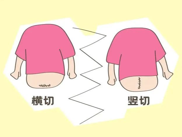 专家科普｜剖宫产后不发愁，与难看的疤痕说拜拜 