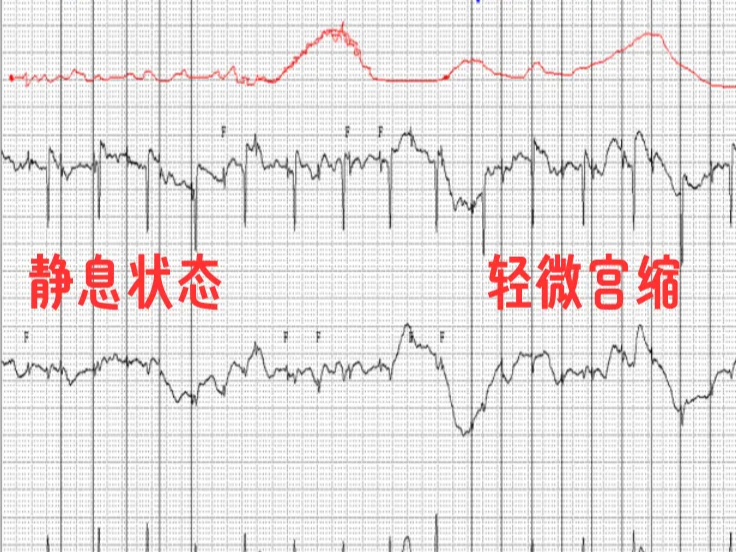 专家科普 | 胎儿也能做心电图吗？