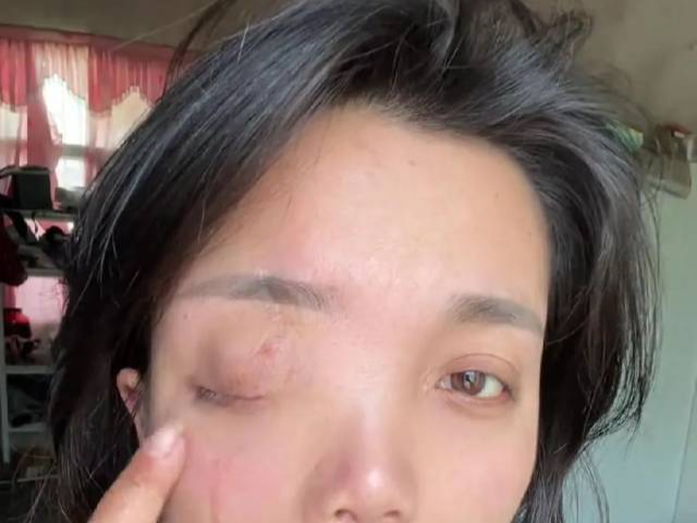 安徽女子左眼失明左耳失聪，办残疾人证被拒？残联：双眼残疾才可办理