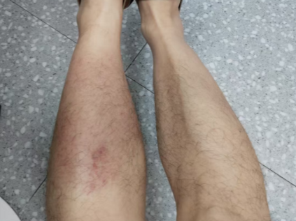 男子蹚水竟染上丹毒！雨天户外行走指南请查收