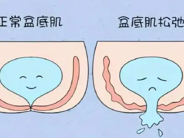 专家科普｜单身、不育就能避免盆底功能障碍吗？ 
