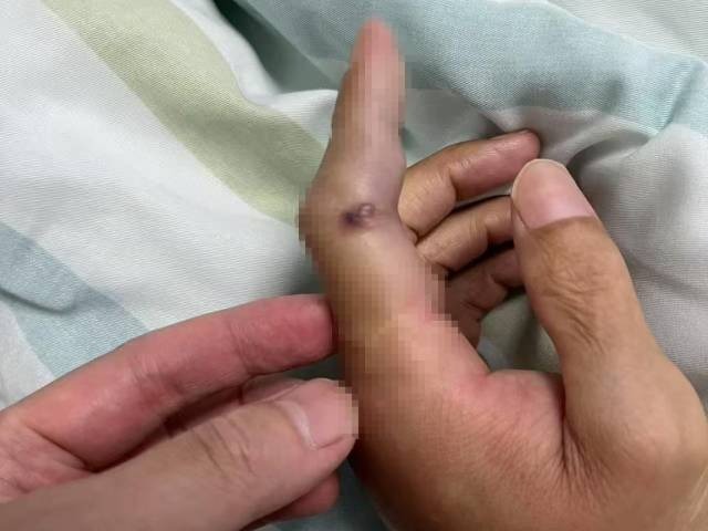 淡水鱼刺伤进ICU！深圳男子差点被一条鱼夺命