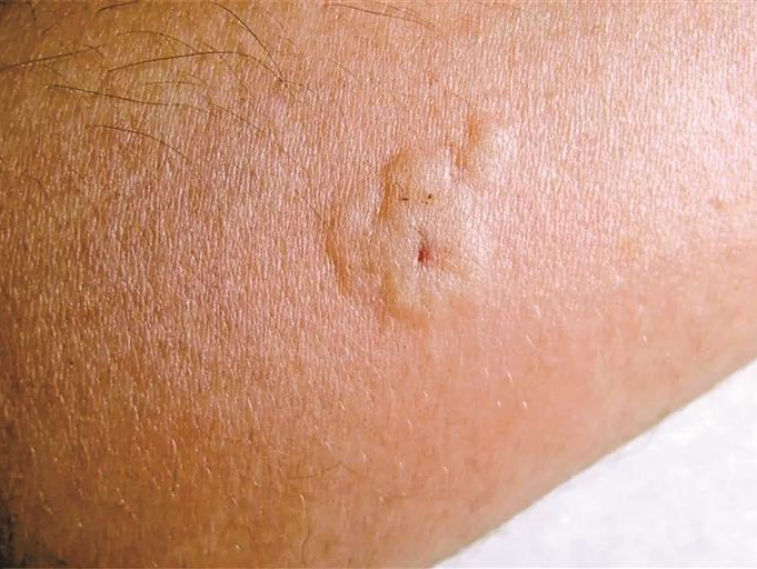 5龄童逗蜜蜂遭“群殴”，医生提醒：毒刺有倒钩不要轻易拔除