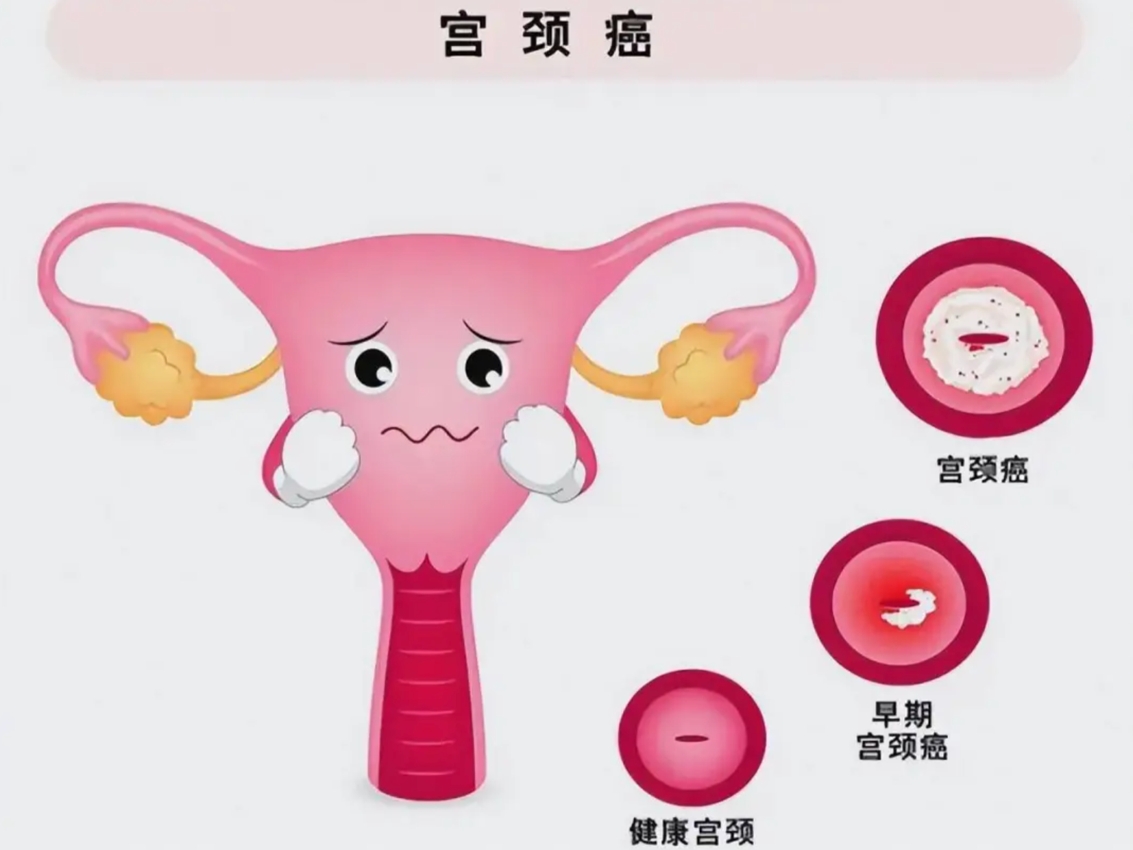 专家科普｜预防宫颈癌，光打疫苗还不够！这套“组合拳”要记牢 