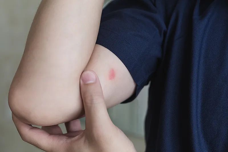 基孔肯雅热能自测吗？专家：不建议！