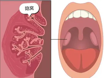 专家科普｜当你吐出一颗扁桃体结石，是选择“扔掉它”还是“闻一下”？