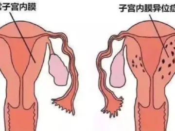直播｜痛经、不孕、同房痛……可能都和内异症有关 