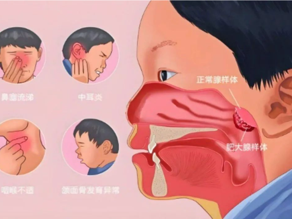 专家科普｜娃总张嘴呼吸？再拖可能变“腺样体面容” 
