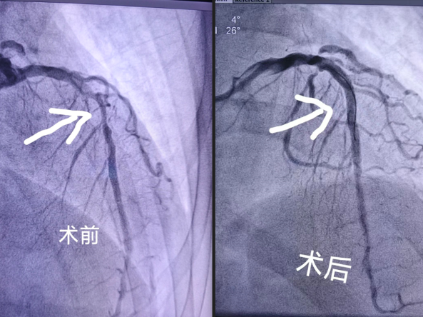 东莞47岁男子胸口痛忍了三天才就诊，一查心脏血管堵了三条