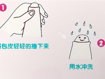 专家科普｜娃割完包皮疼得不敢尿？掌握“黄金3天”护理法 