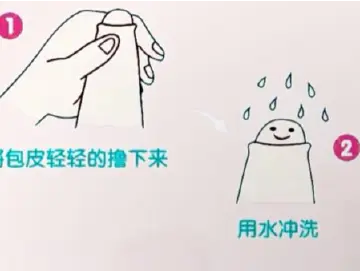 专家科普|娃割完包皮疼得不敢尿?掌握“黄金3天”护理法